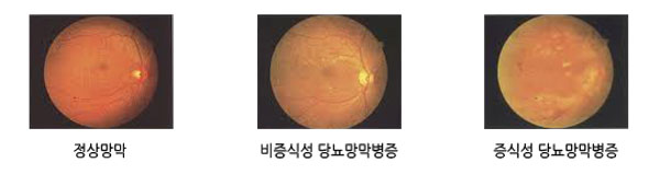 안과(망막, 유리체)