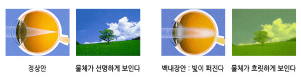 안과(백내장굴절수술)