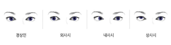 안과(소아사시)